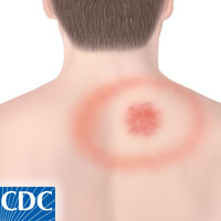 A computer-generated photo of the back of a white individuals upper abdomen is shown, near their right shoulder blade there is a red rash. The rash consists of a completely red dot and then a red outline of a circle around it, resembling a bullseye.