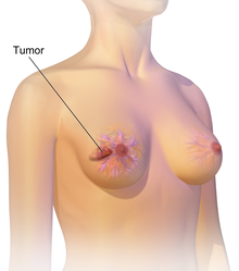 As seen on the image above the breast is already affected with cancer