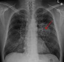 X-ray with an arrow pointing to a hazy circular mass in the chest