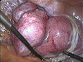 Transvaginal extraction of the uterus in total laparoscopical hysterectomy