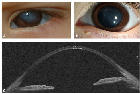Keratoglobus in a case of EDS with brittle cornea syndrome