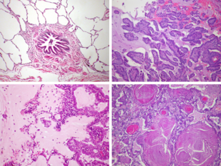 Microscope images of lung tissue. At top-left, healthy lung with clear air-filled alveoli. Others are full of tumor or material, per caption.
