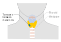 Stage T2 thyroid cancer
