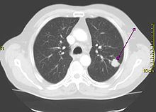CT scan of lung, with tumor appearing as a sharp white shape