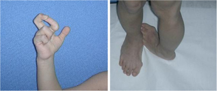 Severe joint hypermobility in a girl with EDS arthrochalasia type