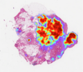 Breast cancer prediction by artificial intelligence on a whole-slide image, an emerging process in digital pathology.[52]