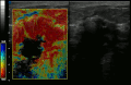 Elastography shows stiff cancer tissue on ultrasound imaging.