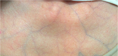Translucent skin in vascular EDS