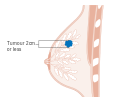 Stage T1 breast cancer