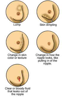 Cartoons of breasts with a lump, skin dimpling, red fluid leaking from the nipple, or changes in the appearance of the skin or nipple