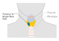 Stage T3 thyroid cancer