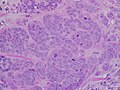 High-grade invasive ductal carcinoma, with minimal tubule formation, marked pleomorphism, and prominent mitoses, 40x field